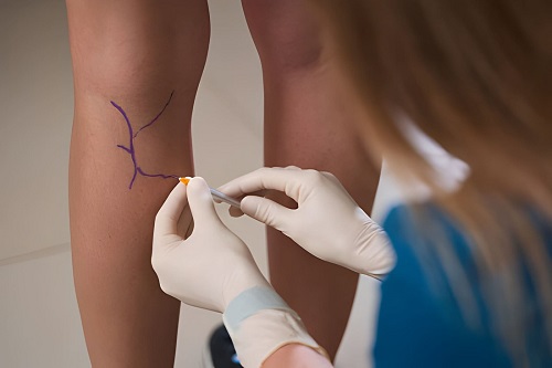 Best Vascular Surgeon in Andheri, Mumbai
